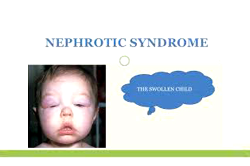 Nephrotic Syndrome 