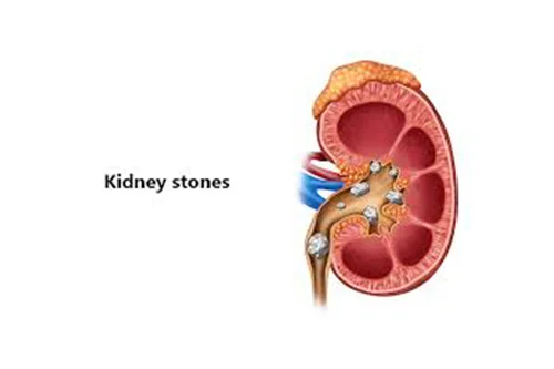kidney Stone Disease