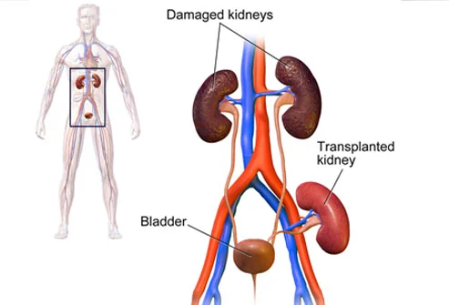 Kidney Transplant Doctor 