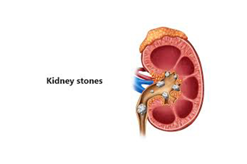Best Kidney Stone Disease